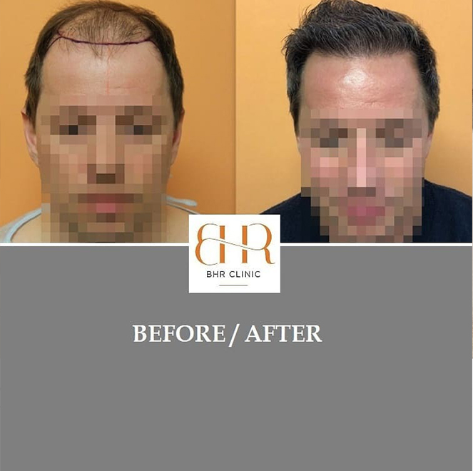 Before and After - Bisanga Hair Restoration - Athens